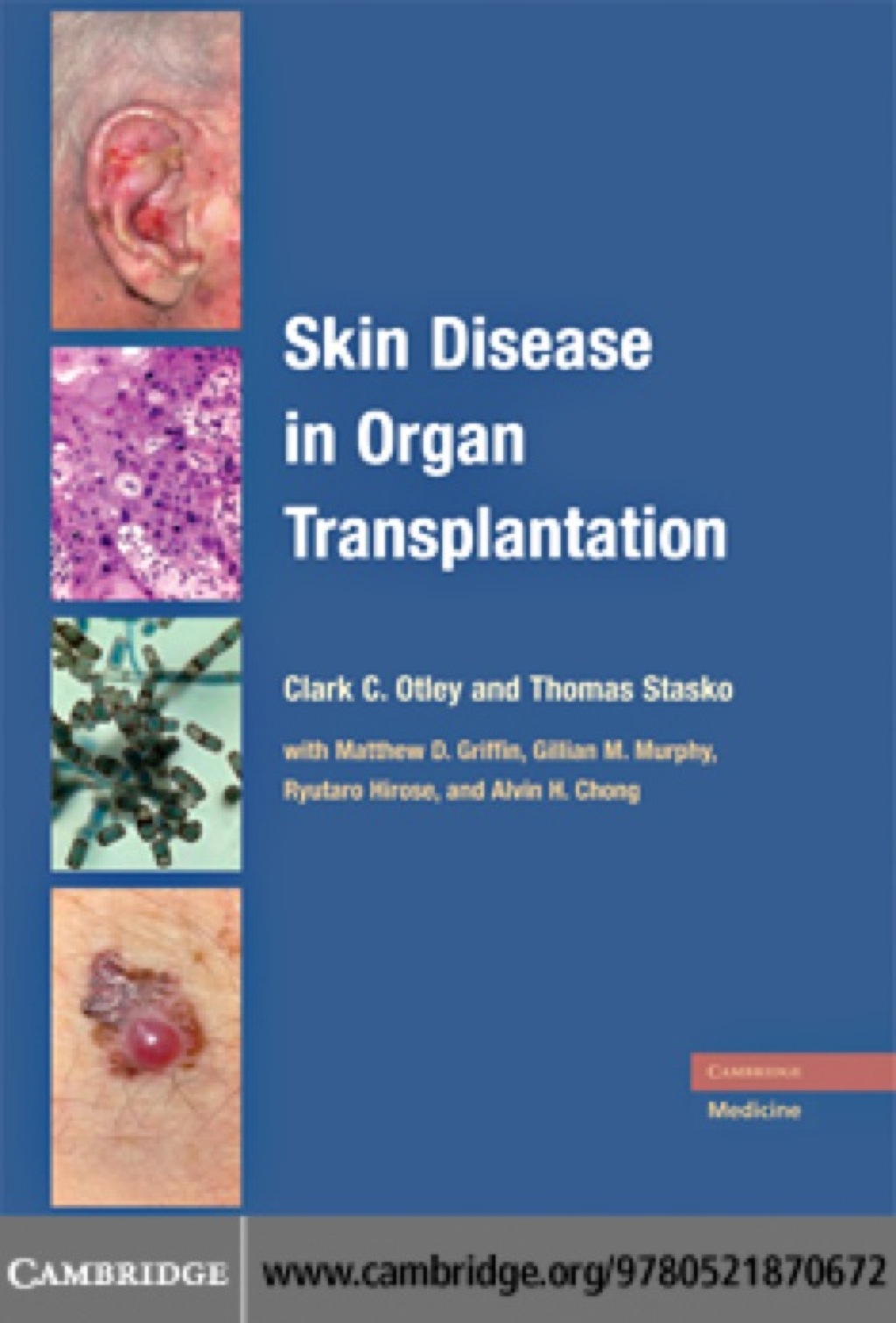 Skin Disease in Organ Transplantation 1st Edition