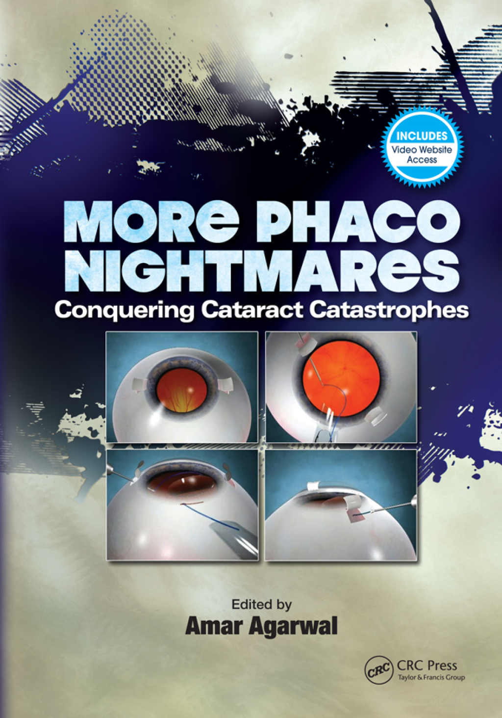 More Phaco Nightmares Conquering Cataract Catastrophes 1st Edition