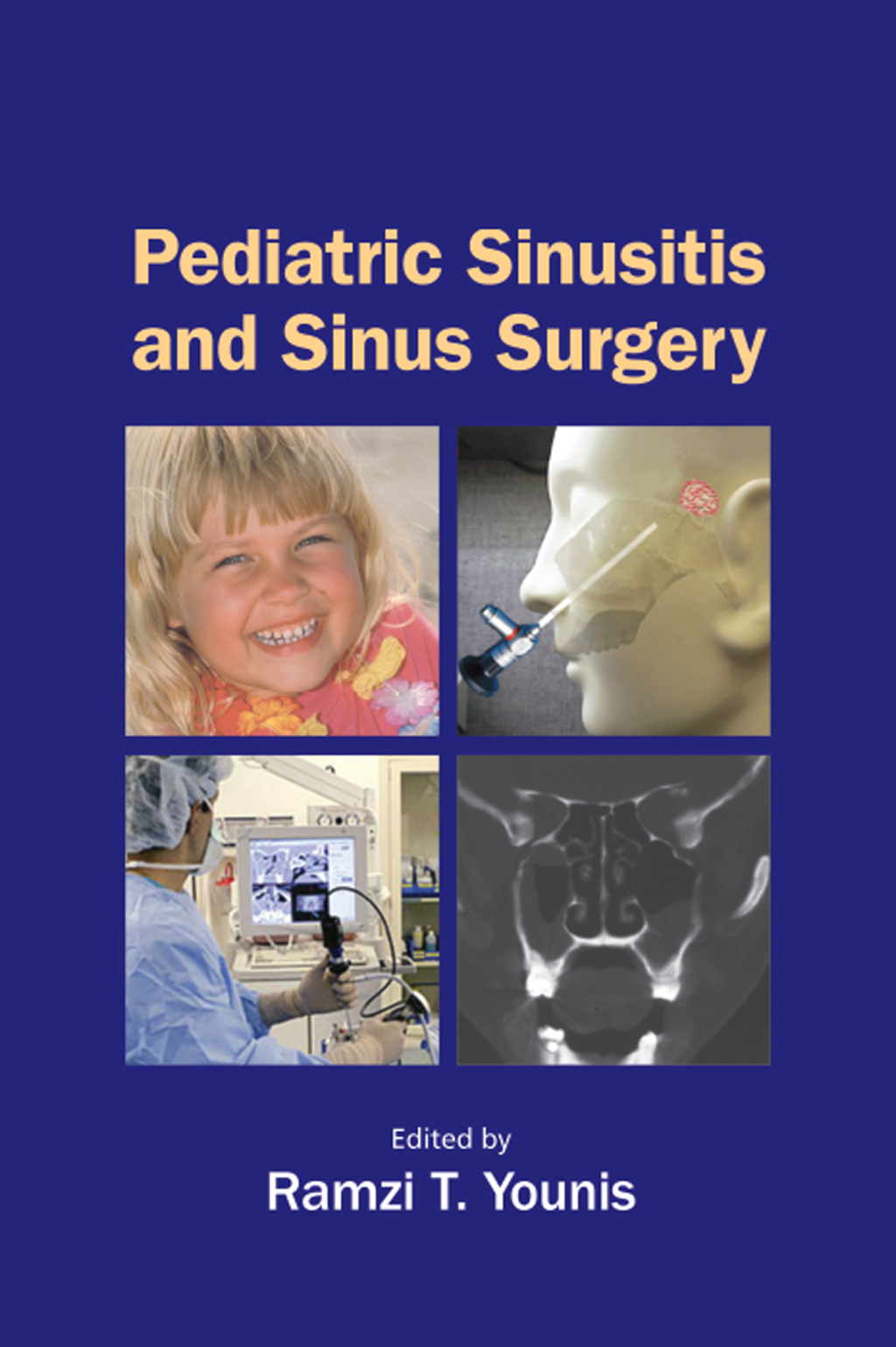 Pediatric Sinusitis and Sinus Surgery 1st Edition