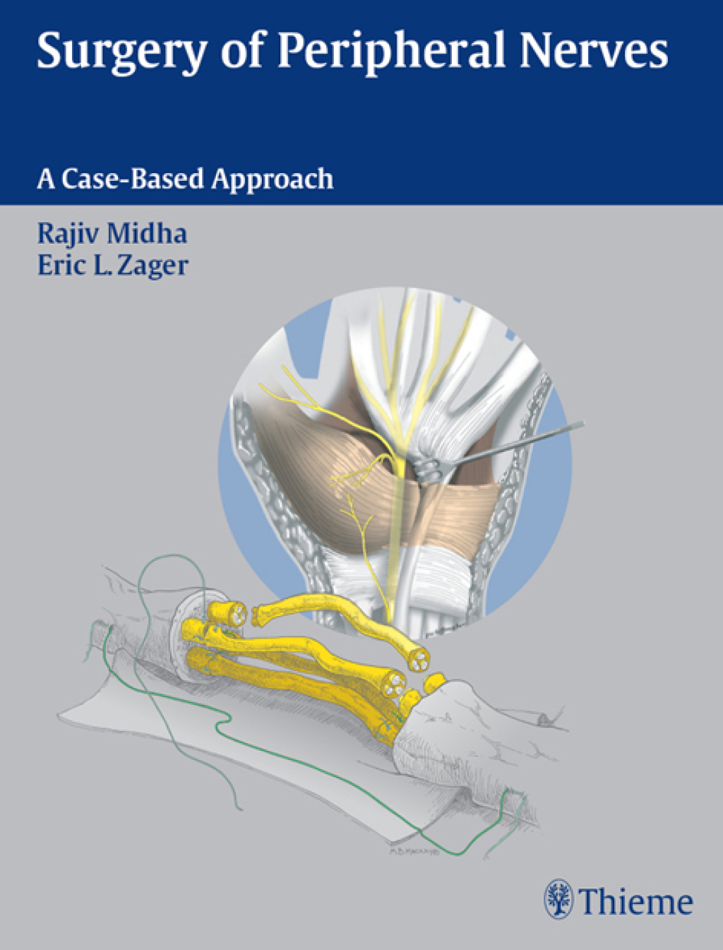 Surgery of Peripheral Nerves A Case-Based Approach 1st Edition