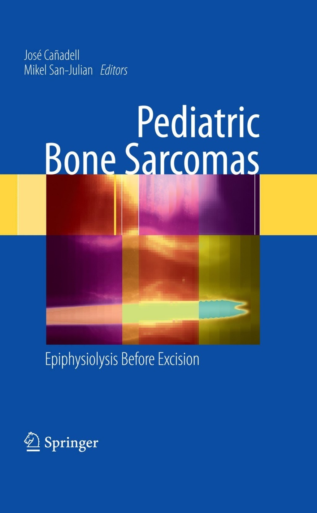 Pediatric Bone Sarcomas Epiphysiolysis before excision 1st Edition